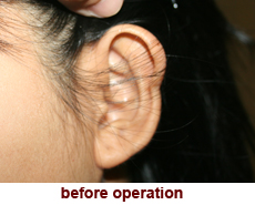 plastic-surgery-prominent-ear 